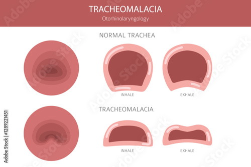 Tracheomalacia disease. Pulmonology, otolaryngology. Medical infographic design. Vector illustration