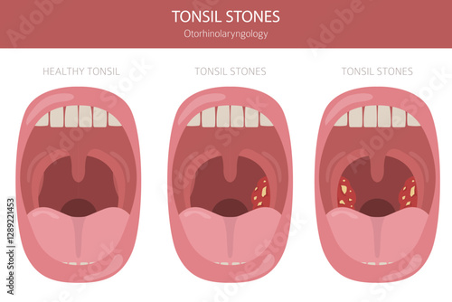 Tonsil stones diseases. Otorhinolaryngology. chronic caseous tonsillitis. Medical infographic design. Vector illustration