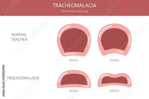 Tracheomalacia disease. Pulmonology, otolaryngology. Medical infographic design. Vector illustration