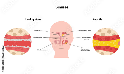 Sinuses anatomy healthy sinus and sinusitis. Nose nasal anatomy. Inflammation Nasal Cavity