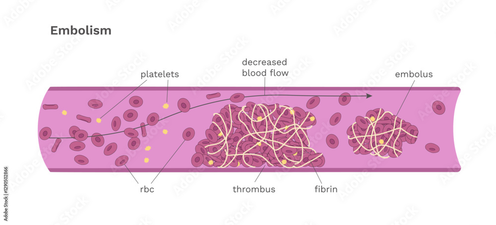 Embolism medical chart with captions. Blood clot movement in the blood vessel Embolism medical chart with captions. Blood clot movement in the blood vessel