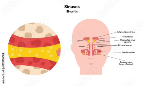 Sinuses anatomy sinusitis. Nose nasal anatomy. Inflammation Nasal Cavity