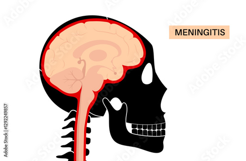 Meningitis medical poster