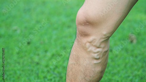 Bild auf Leinwand Varicose veins on the legs of men
