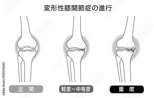 変形性膝関節症の進行を表したモノトーンのイラスト