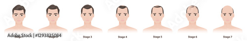 The stages of male pattern hair loss vector illustration isolated on white background. The Norwood scale defines seven stages of male pattern baldness or androgenetic alopecia. Hair care concept.