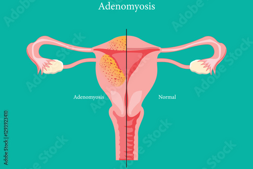 illustration of  adenomyosis symptoms versus a healthy uterus. medical illustration. eps 10