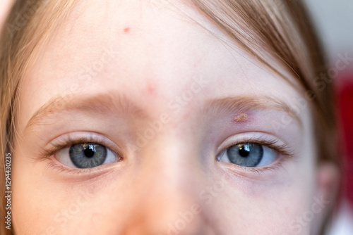 Obraz na płótnie Varicella virus or Chickenpox bubble rash on child w salonie