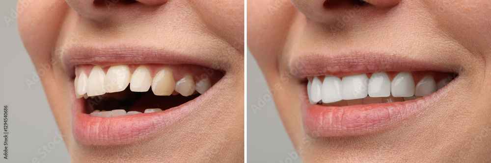 Obraz premium Woman smiling before and after procedure dental veneers placement on grey background, closeup. Aesthetic improvement of teeth, collage