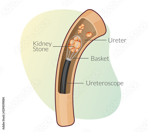 Kidney Stone Removal - Percutaneous Nephrolithotomy - Stock Illustration