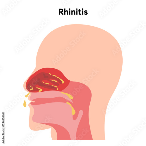 Nose Nasal diseases. Rhinitis symptoms. Allergy, rhinitis or cold medical diagram