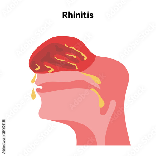 Nose Nasal diseases. Rhinitis symptoms. Allergy, rhinitis or cold medical diagram