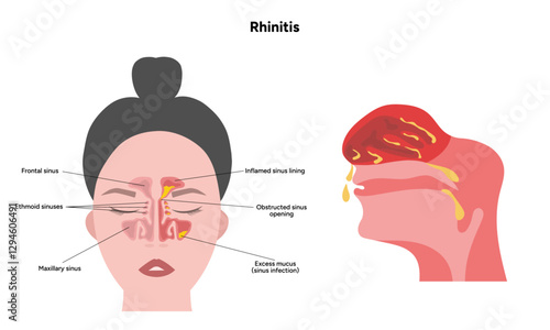 Nose Nasal diseases. Rhinitis symptoms. Allergy, rhinitis or cold medical diagram