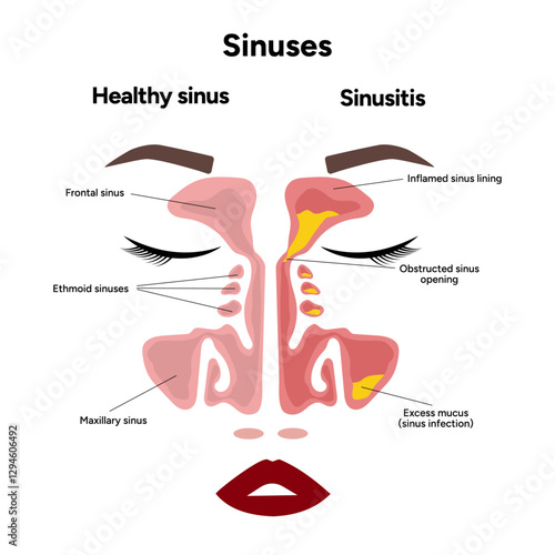 Sinuses anatomy sinusitis. Nose nasal anatomy. Inflammation Nasal Cavity