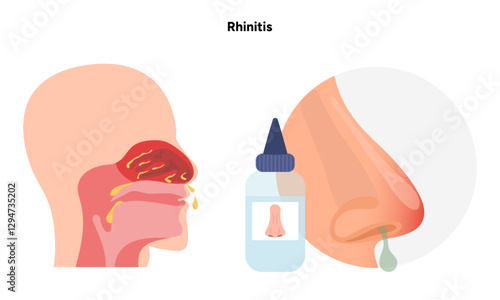 Nose Nasal diseases. Rhinitis symptoms. Allergy, rhinitis or cold medical diagram with nasal spray