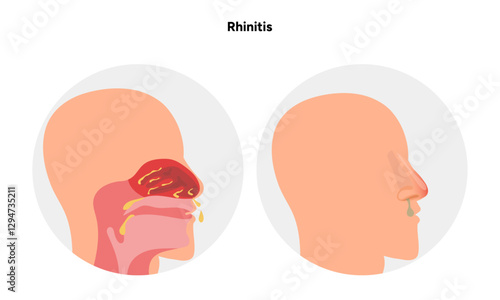 Nose Nasal diseases. Rhinitis symptoms. Allergy, rhinitis or cold medical diagram