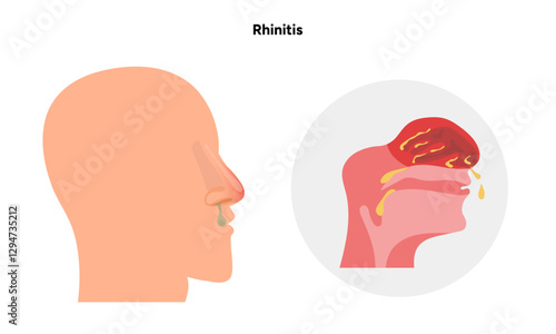 Nose Nasal diseases. Rhinitis symptoms. Allergy, rhinitis or cold medical diagram