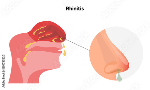 Nose Nasal diseases. Rhinitis symptoms. Allergy, rhinitis or cold medical diagram