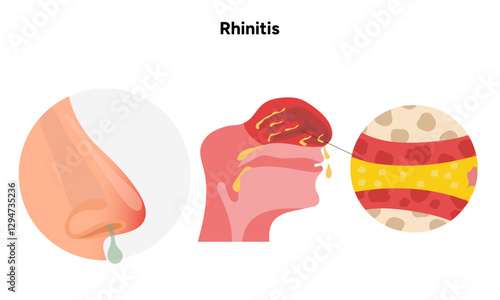 Nose Nasal diseases. Rhinitis symptoms. Allergy, rhinitis or cold medical diagram