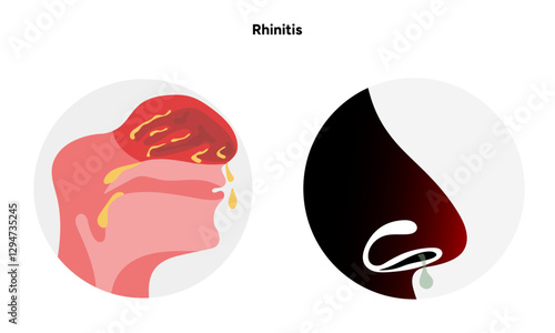 Nose Nasal diseases. Rhinitis symptoms. Allergy, rhinitis or cold medical diagram