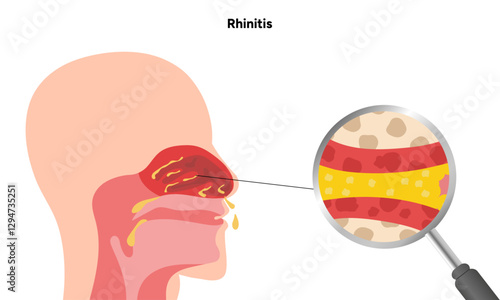 Nose Nasal diseases. Rhinitis symptoms. Allergy, rhinitis or cold medical diagram