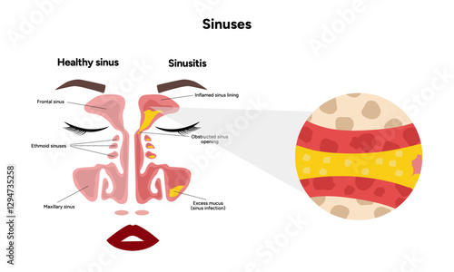 Sinuses anatomy sinusitis. Nose nasal anatomy. Inflammation Nasal Cavity