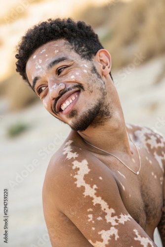 A confident young man with vitiligo and short hair. His unique skin patterns are highlighted by soft natural light. He radiates self-love and strength, embracing her natural beauty.