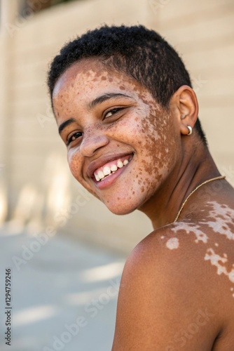 A confident young woman with vitiligo and short hair. Her unique skin patterns are highlighted by soft natural light. She radiates self-love and strength, embracing her natural beauty