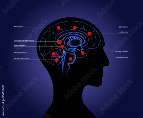 Primary brain tumors