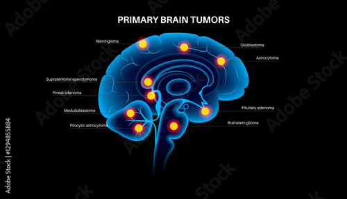 Primary brain tumors
