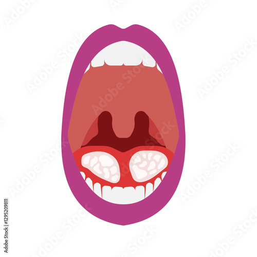 oral candidiasis
