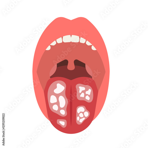 oral candidiasis