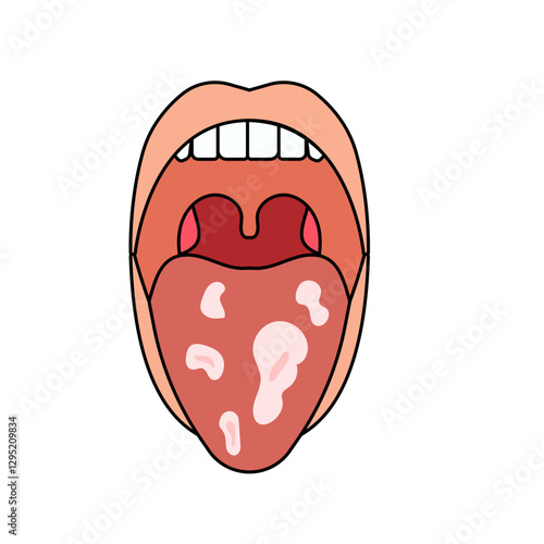 oral candidiasis