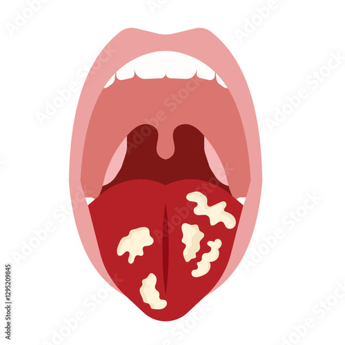 oral candidiasis