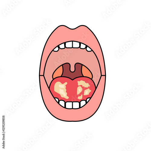 oral candidiasis