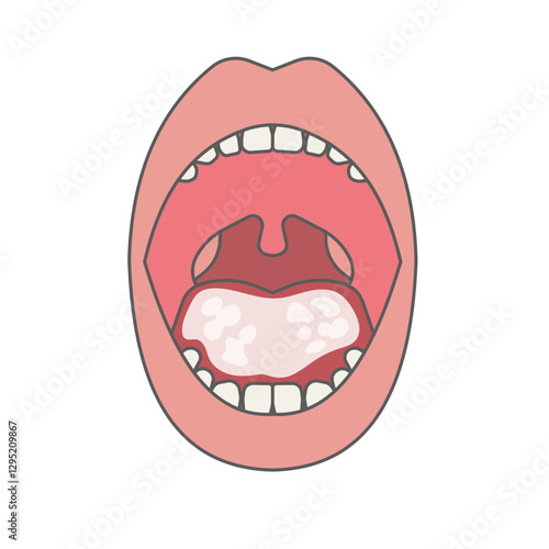 oral candidiasis