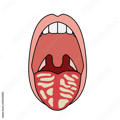 oral candidiasis