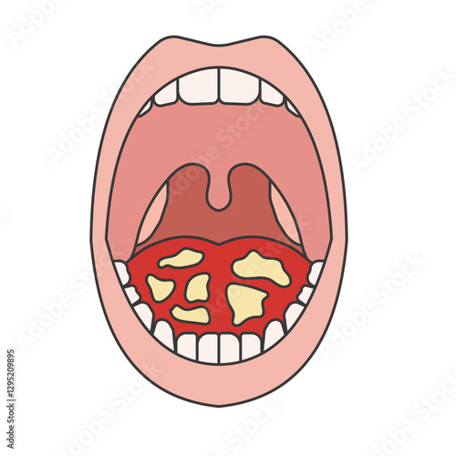 oral candidiasis