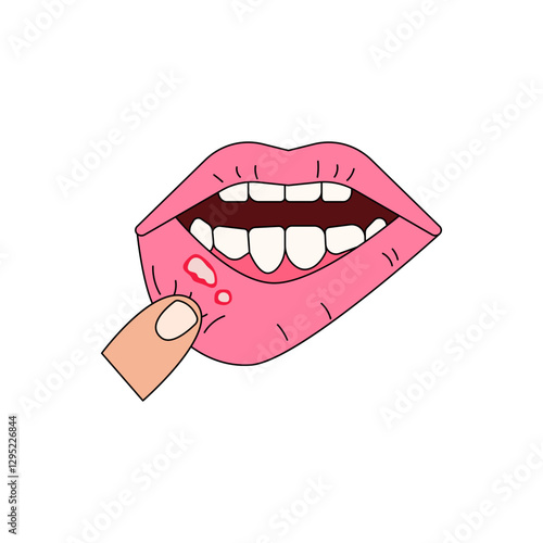 oral ulcer