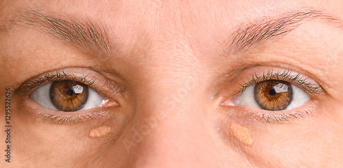 Brown eyes of an adult woman with pathology of cholesterol plaques and drooping eyelid