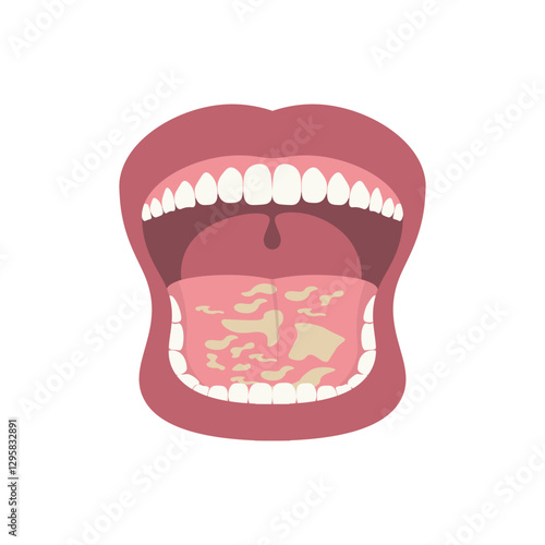 Oral Thrush Illustration