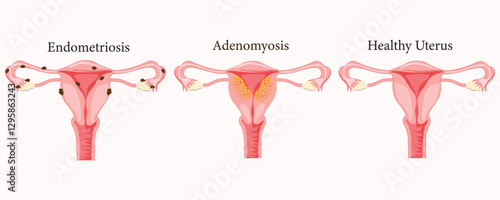 Medical illustration comparing endometriosis, adenomyosis, and a healthy uterus condition. eps 10