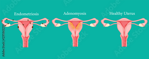 Medical illustration comparing endometriosis, adenomyosis, and a healthy uterus condition.