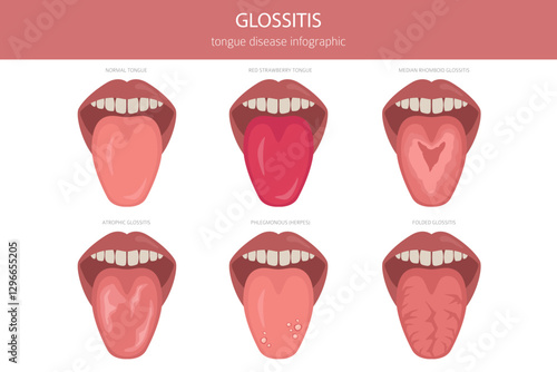 Glossitis tongue disease. Oral medicine. Medical infographic design. Vector illustration