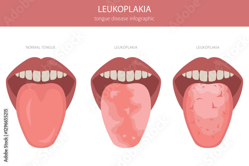 Leukoplakia tongue disease. Oral medicine. Medical infographic design. Vector illustration