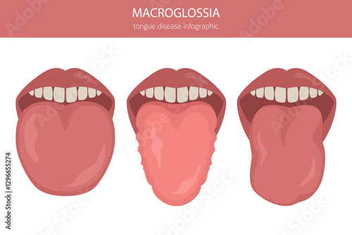 Macroglossia tongue disease. Oral medicine. Medical infographic design. Vector illustration