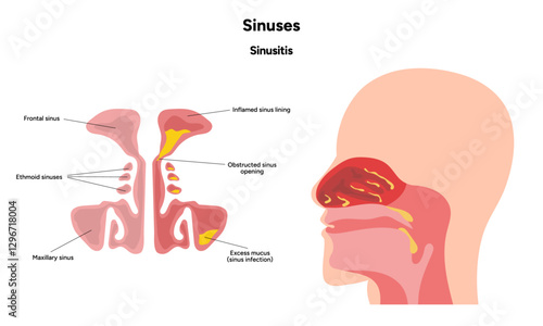 Nose Nasal diseases. Rhinitis symptoms. Allergy, rhinitis, cold medical diagram