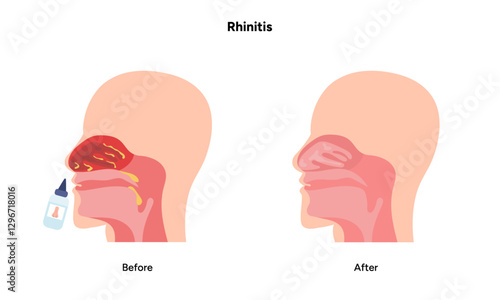 Nose Nasal diseases. Rhinitis symptoms. Allergy, rhinitis, cold medical diagram