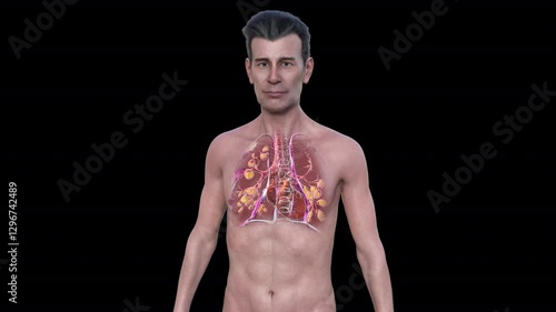 A man with lungs affected by cystic fibrosis, a genetic disorder causing thick mucus production. 3D animation shows bronchi dilation due to mucus accumulation and inflammation.