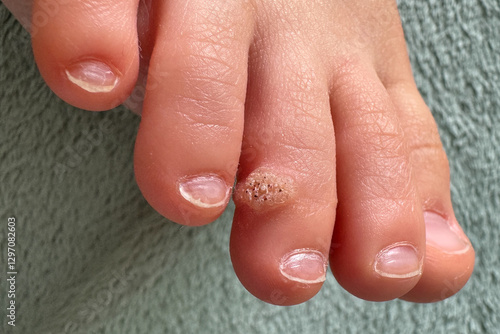 Close-up of a child's foot showing a wart on toe. The skin texture and growth are clearly visible, highlighting a common dermatological condition